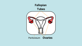 Heating Up Hope: HIPEC and the Future of Ovarian Cancer Care
