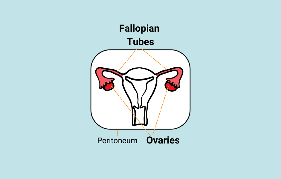 Heating Up Hope: HIPEC and the Future of Ovarian Cancer Care