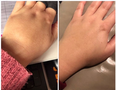 Before and after pics of a lady with lymphoedema in hand after breast cancer and lymph node removal.