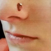 Bleeding