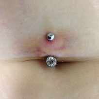 Bruising