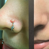 Localized Piercing Pimple