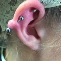 Keloid