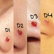 Granuloma
