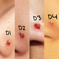 Granuloma