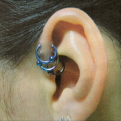 Hypertrophic Scarring