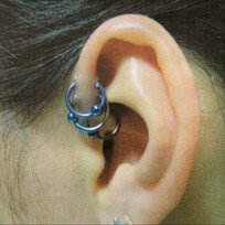Hypertrophic Scarring