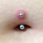 Swelling