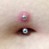 Swelling
