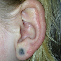 Argyria