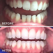 clear aligners vineyard dental spa