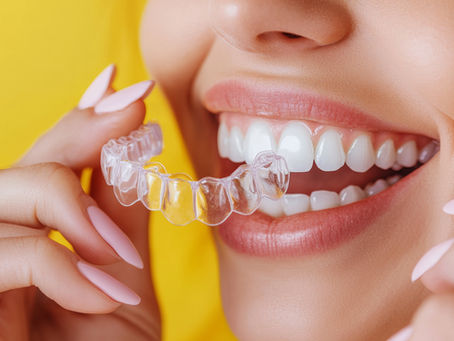 Straightening Mildly Crowded Teeth with Invisalign