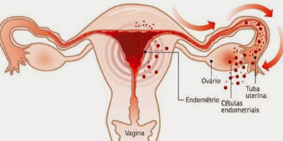Endometriose: o que é preciso saber sobre ela.