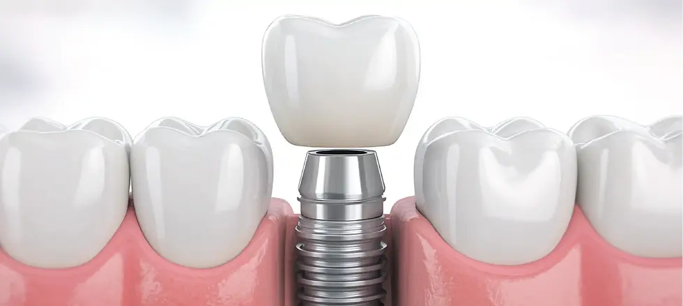 dental implant_compressed.webp