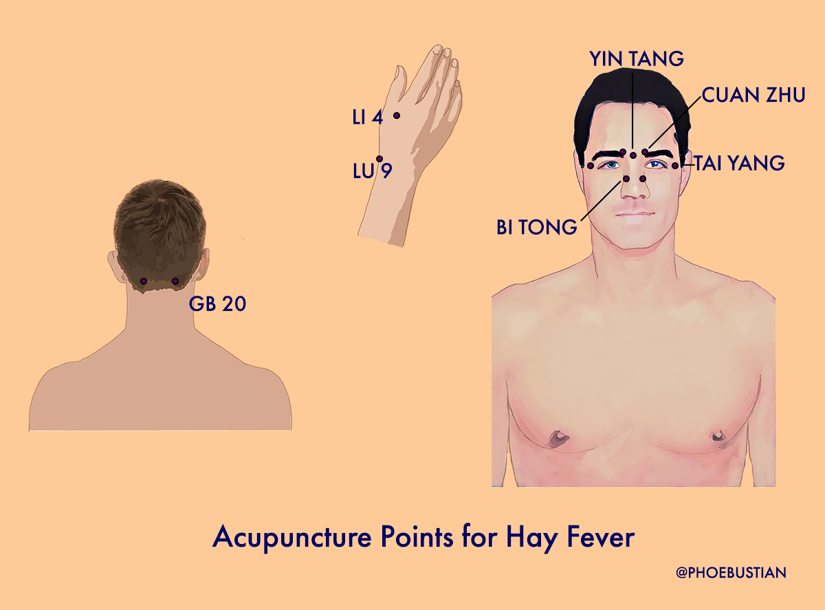 Acupuncture points for hay fever