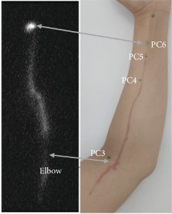 acupuncture points PC5
