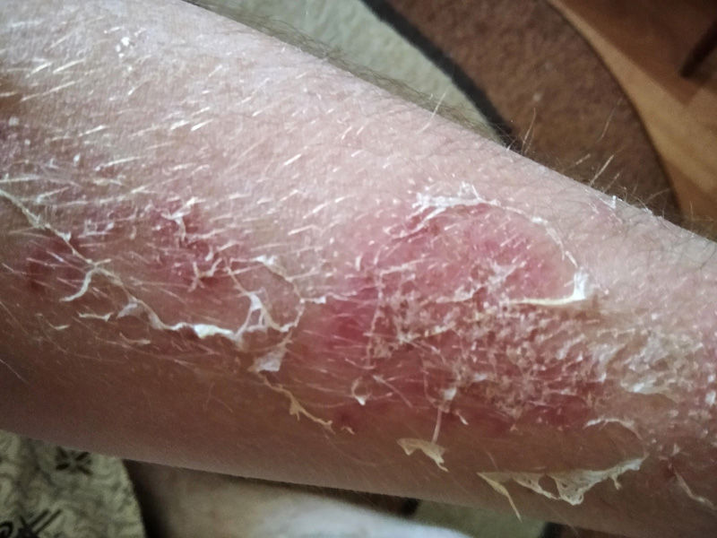Close-up of a forearm with red, peeling, and flaky skin. The background includes a carpet and floor, indicating an indoor setting.