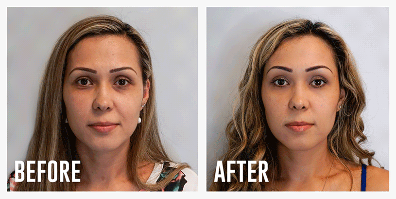 Plasma Fibroblast for Upper Eyelids