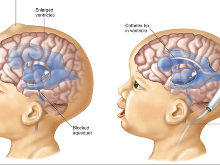 "Υδροκέφαλο"