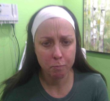 Pierson, K squinting pre botox_00_00.jpg