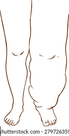 lymphedema-disease-2.webp