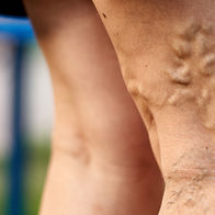 Krampfadern, Varizenoperationen, Venen, Gefässchirurgie in Zürich, Hirslanden