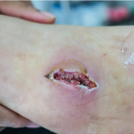 Diabetischer Fuss, Gefässchirurgie, Hirslanden