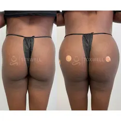 Side-by-side comparison of a woman's lower back and buttocks, possibly after a liquid BBL in Miami. 