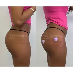 Side-by-side comparison of a woman's lower back and buttocks, possibly after a liquid BBL in Miami.