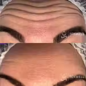 A before-and-after image of a forehead shows deep wrinkles erased after Botox injections in Hallandale and Aventura and Hollywood areas at Toxwell Med Spa. Both images display the "TOXWELL MED SPA + WELLNESS" logo in the lower right corner.