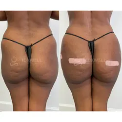 Side-by-side comparison of a woman's lower back and buttocks, possibly after a liquid BBL in Miami. 