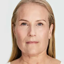 Ultherapy: Non-Invasive Skin Tightening & Lifting Treatment