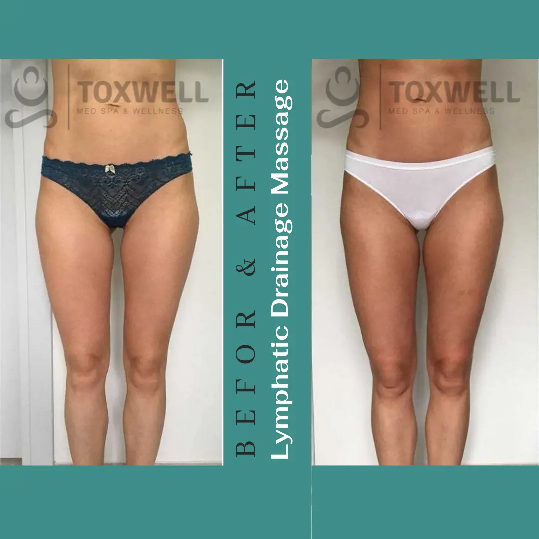 Body contouring