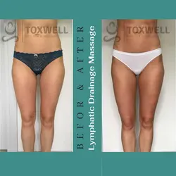 Endosphere Lympathic Drenage