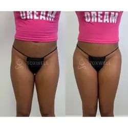 Side-by-side comparison of a woman's lower back and buttocks, possibly after a liquid BBL in Miami.