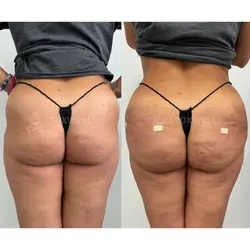 Side-by-side comparison of a woman's lower back and buttocks, possibly after a liquid BBL in Miami. 