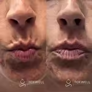 Close-up of an older person's pursed lips and surrounding wrinkled skin, shown in two side-by-side images. The smoother, refreshed appearance in the bottom image highlights results from Lip Flip Botox Injections in Hallandale and Hollywood at Toxwell Med Spa.