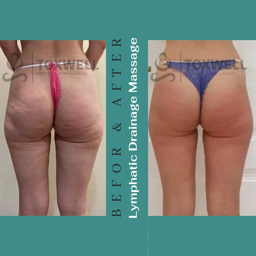 Body contouring