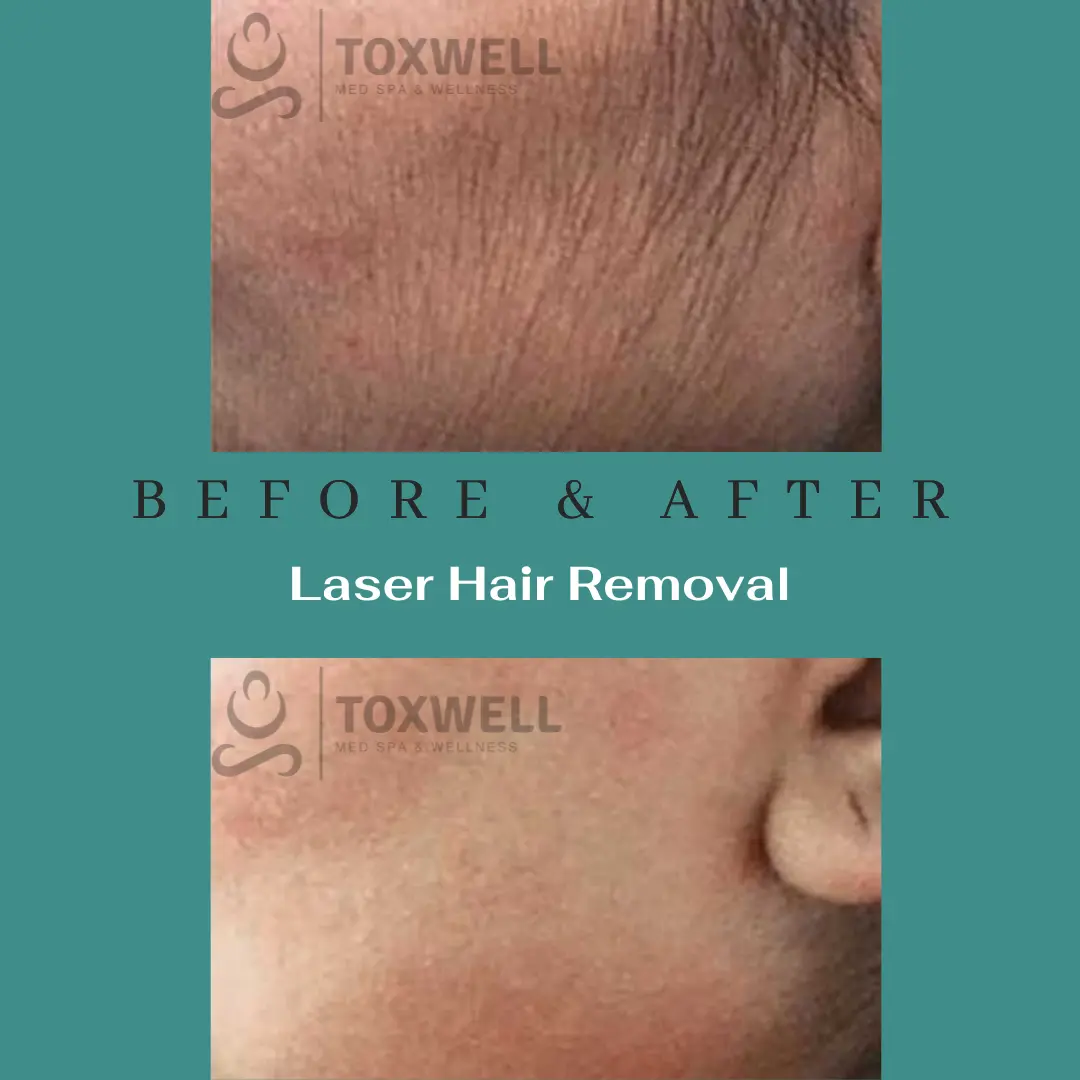 Laser Hair Removal