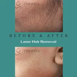 Laser Hair Removal