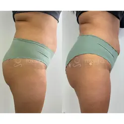 sculptra_liquid_bbl_non-surgical_brazilian_butt_lift
