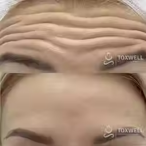 A before-and-after image of a forehead shows deep wrinkles erased after Botox injections in Hallandale and Aventura and Hollywood areas at Toxwell Med Spa. Both images display the "TOXWELL MED SPA + WELLNESS" logo in the lower right corner.
