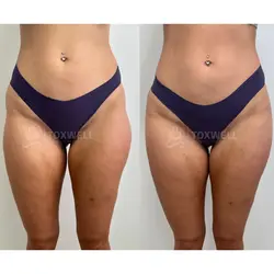 Side-by-side comparison of a woman's lower back and buttocks, possibly after a liquid BBL in Miami. 