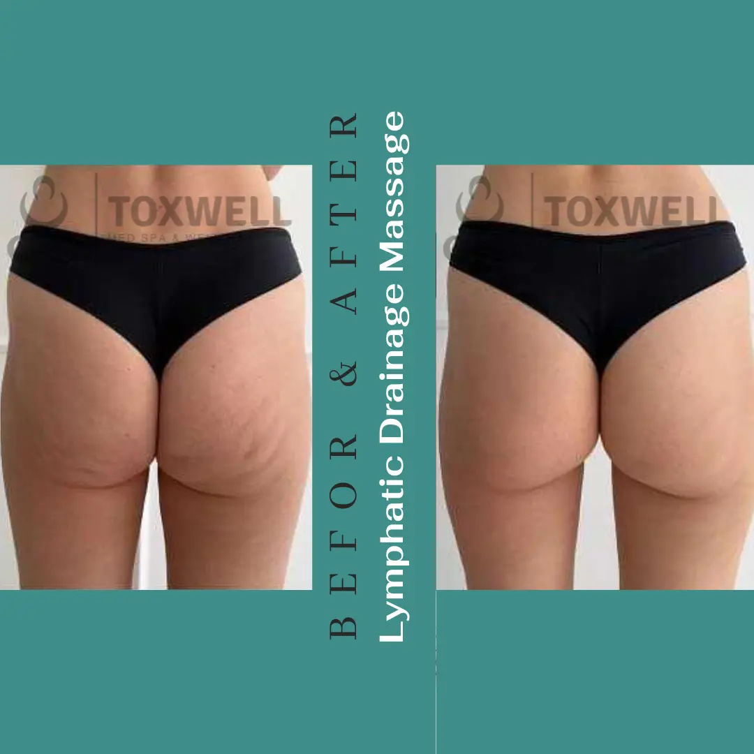 Body contouring