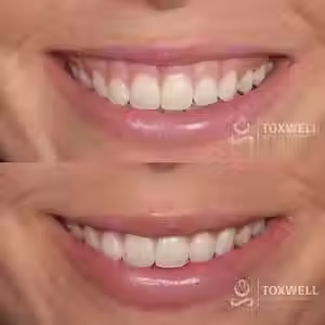 A close-up of a man's smile before and after treatment. The top shows a gummy smile, while the bottom reveals less gum exposure after Gummy Smile Botox injections in Hallandale and Hollywood areas at Toxwell Med Spa. Toxwell logo appears in both images.