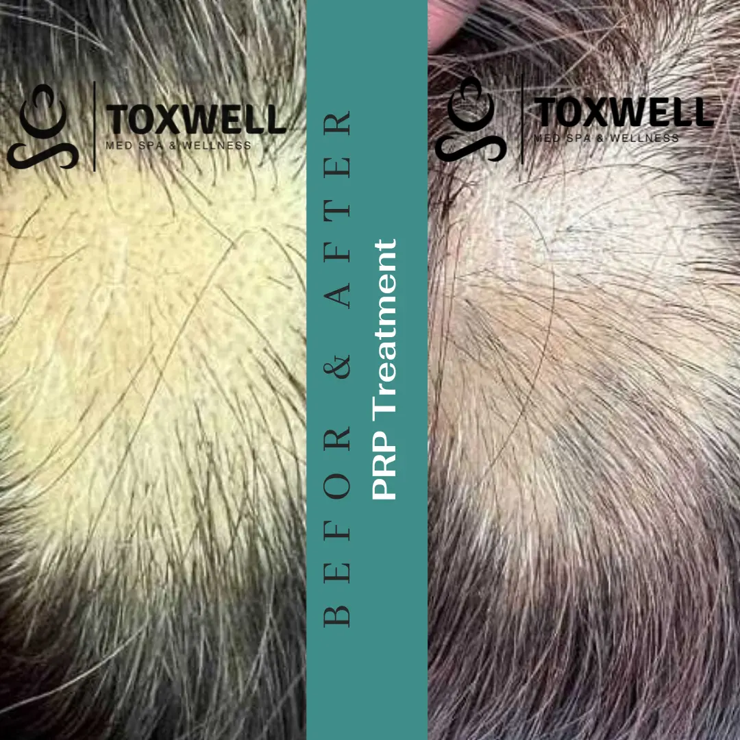PRP Hair Loss Treatment