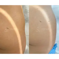 sculptra_liquid_bbl_non-surgical_brazilian_butt_lift
