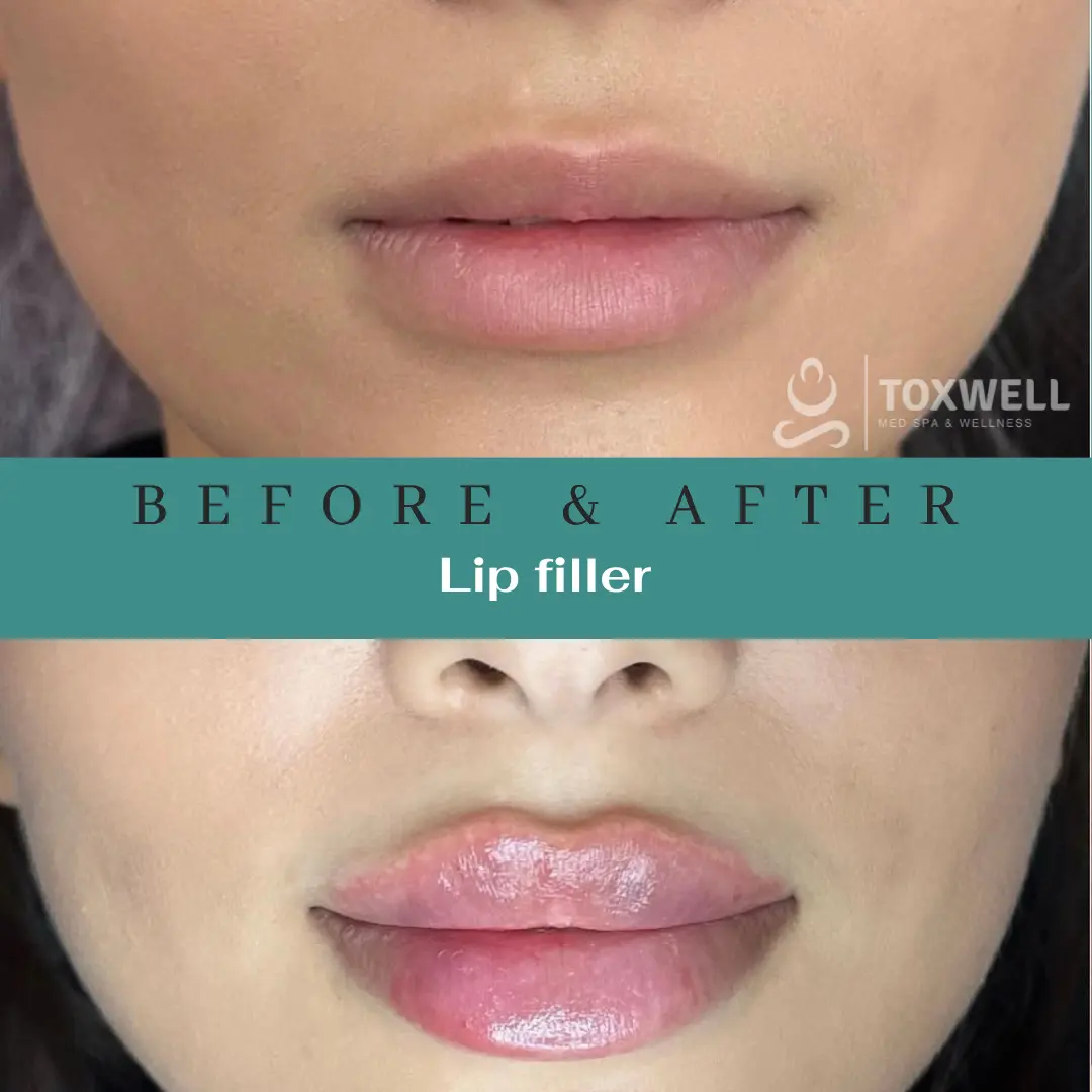 Dermal Filler