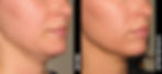 Side-by-side images of a woman's face before and after 120 days. Visible improvement in skin texture and reduced chin area.