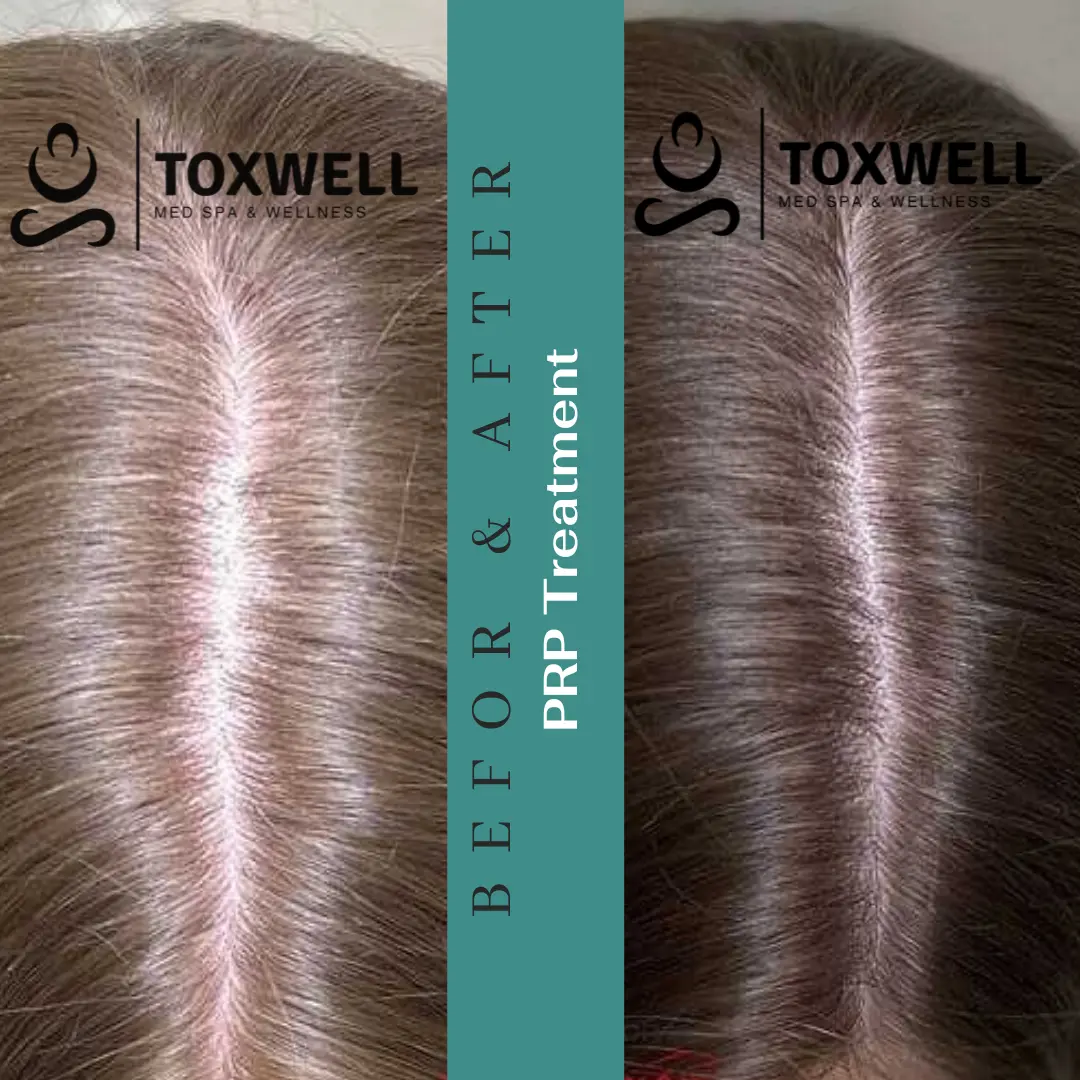 PRP Hair Loss Treatment